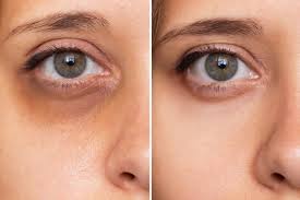 Anti-Dark Circle Eye Roller